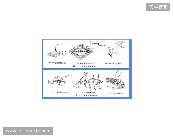 广州豹官方:杨浩眉弓伤口缝合30余针,预计5-7天后拆线 广州豹官方:杨浩眉弓伤口缝合30余针,预计5-7天后拆线
